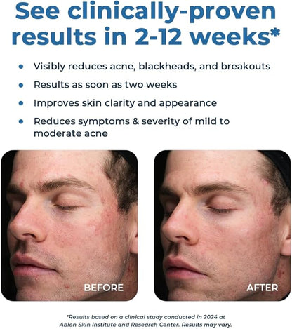 VitaMedica Clear Skin Vitamin Formula | Acne Supplement for Skin Clearing | Breakout Treatment for Women and Men | Vitamins A, C, E, Selenium, Chromium, and Zinc for Acne and Skin Health | 60 Count