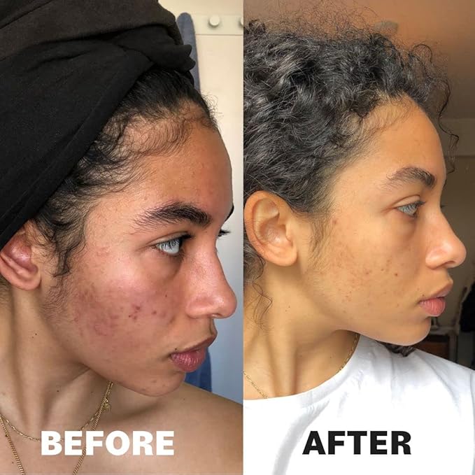 POREFAVOR Acne Supplements – Includes DIM, Zinc + 10 actives targeting the 4 stages of acne development Clear Skin Vitamins for Spots, Blemishes & Oil Control, for Women, Men, & Teens (1 Month Supply)