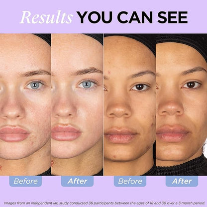 ZitSticka Vitamin Acne Supplement for Cystic Acne w/ 30 Natural Caps for Women and Men, Supplements for Hormonal Support, Skin Clarity, Dark Spots - Dermatologist Tested (After Hours Ceramides)